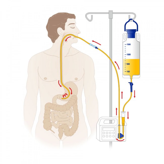 Набор для энтерального питания гравитационный с мешком 1000мл Медерен (Mederen Neotech Ltd.) Израиль Набор для энтерального питания гравитационный с мешком 1000мл Медерен (Mederen Neotech Ltd.) Израиль