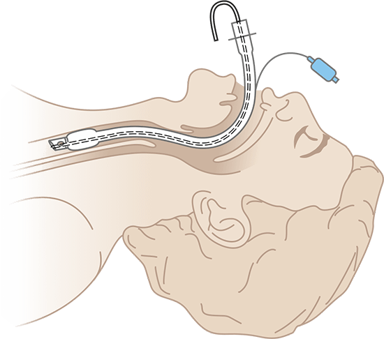 Стилет для эндотрахеальных трубок, CH/Fr 10,  Апексмед (Apexmed International B.V.) Нидерланды Стилет для эндотрахеальных трубок, CH/Fr 10,  Апексмед (Apexmed International B.V.) Нидерланды